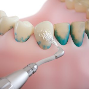 professional teeth cleaning/ step 2: powder stream treatment 